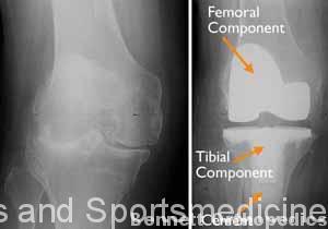 (Left) An x-ray of a severely arthritic knee. (Right) The x-ray appearance of a total knee replacement. Note that the plastic spacer between the bones does not show up in an x-ray.
