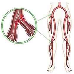 Blood clots may develop in leg veins.