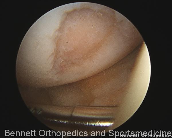 This is an arthroscopic photo showing an acute injury to the articular cartilage of the knee.