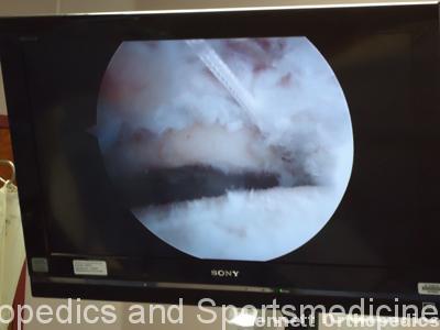 This is an arthroscopic photo which illustrates a technique for performing a hip labral reconstruction with a cadaveric fascia lata allograft.