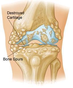 This knee shows that with arthritis, cartilage is gone and spurring can occur. Often there is subchondral bone changes.