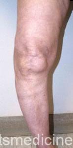 A knee that has become bowed as a result of severe arthritis.