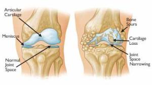 Osteoarthritis often results in bone rubbing on bone. Bone spurs are a common feature of this form of arthritis.