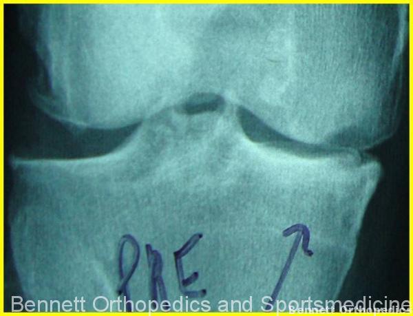 This xray shows a knee with medial compartment arthritis.
