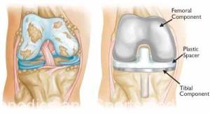 (Left) Severe osteoarthritis. (Right) The arthritic cartilage and underlying bone has been removed and resurfaced with metal implants on the femur and tibia. A plastic spacer has been placed in between the implants. The patellar component is not shown for clarity.