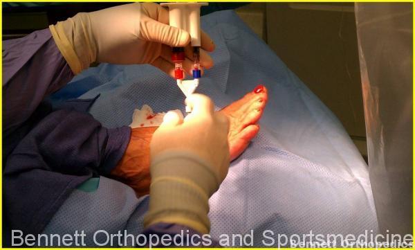 prp-ankle-foot